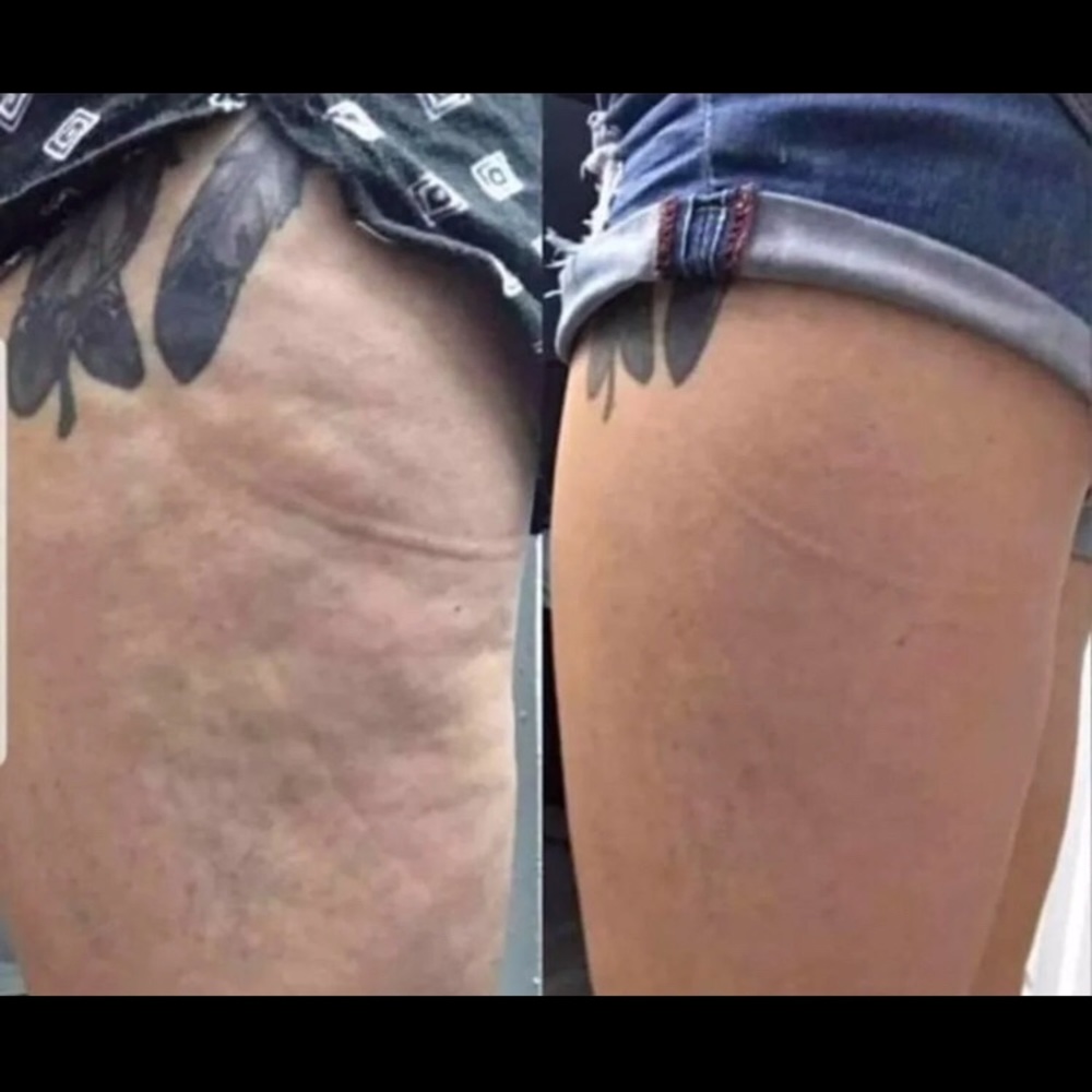 Dermatic Effects Cellulitis Lotion - Picture 2 of 3